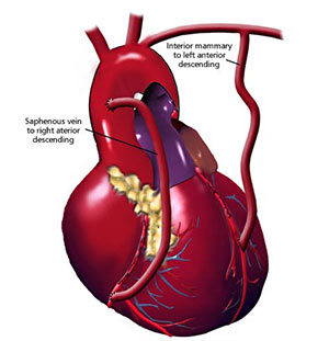 coronary_artery_bypass_3