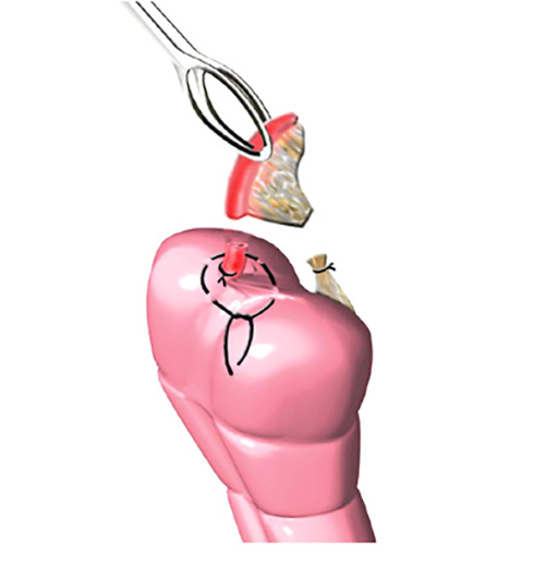 reusable purse string clamp/surgical instruments| Alibaba.com-cheohanoi.vn