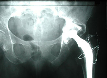 total_hip_replacement_2