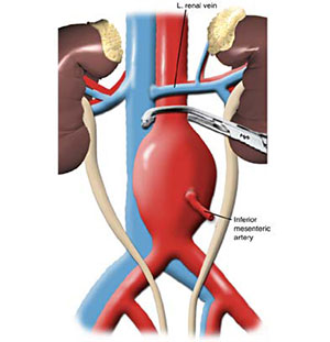 abdominal_aortic_aneurysm_repair_1