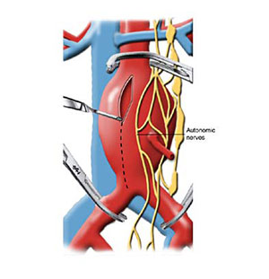 abdominal_aortic_aneurysm_repair_2