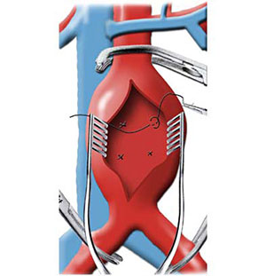abdominal_aortic_aneurysm_repair_3