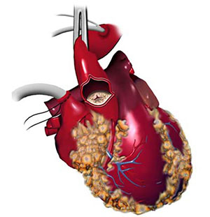 cardiac_valve_surgery_1