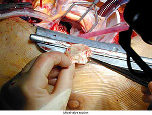 cardiac_valve_surgery_2