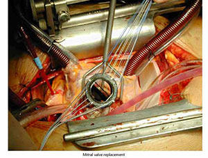 cardiac_valve_surgery_4