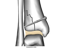 common_fracture_8